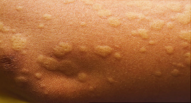 orticaria psicosomatica sintomi